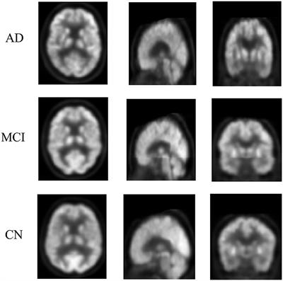 Frontiers | Broad Learning For Early Diagnosis Of Alzheimer's Disease ...